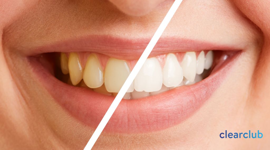 Teeth Whitening Mouth Guards