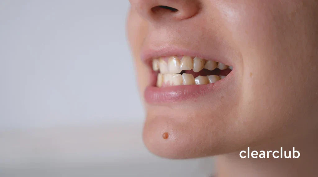Close-up of a woman with yellow-stained teeth