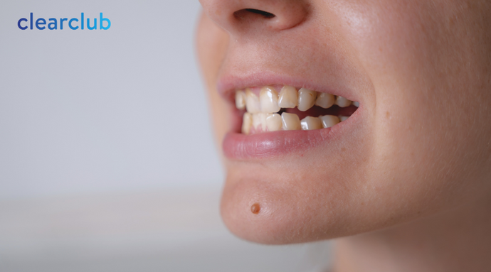 Tooth Stain Colors Explained: What Yellow, Gray, and Purple Teeth Really Mean
