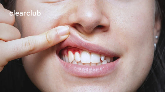 Woman lifting her lip to show inflamed gums, a common sign of gingivitis.