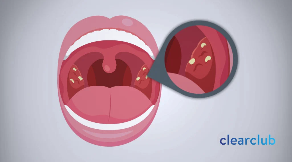 Illustration showing tonsil stones forming in the tonsil crypts