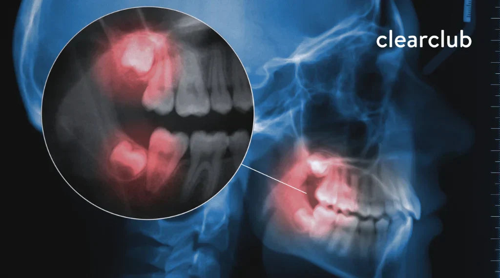 A side view of an X-ray of a person’s teeth, with the wisdom teeth being highlighted and zoomed in for emphasis.