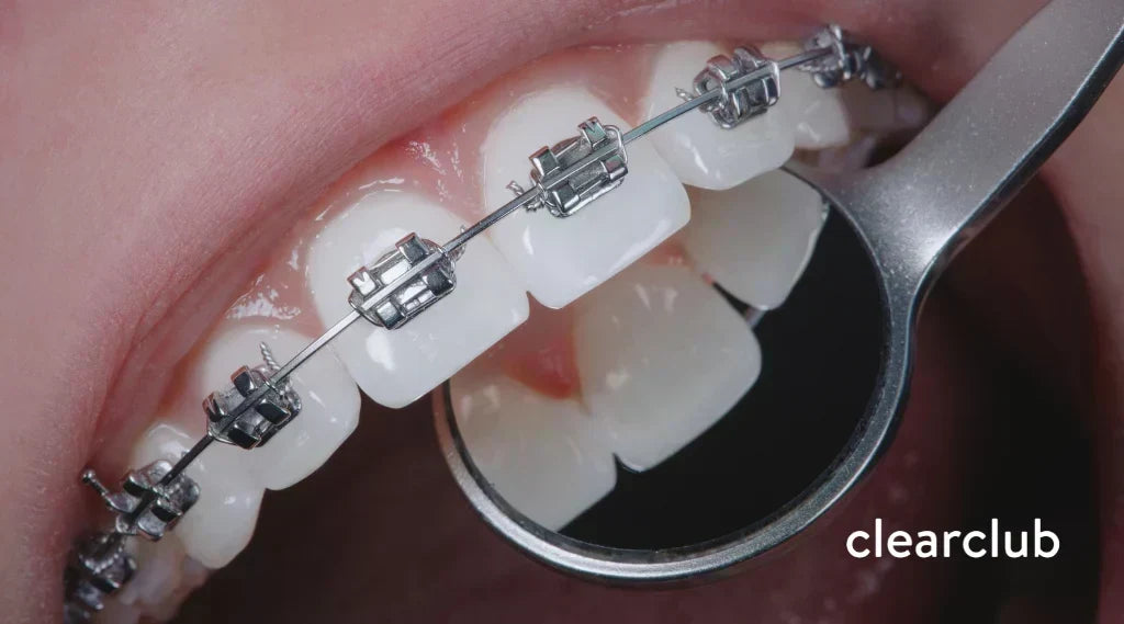Close-up of a dentist checking the underside of a patient’s teeth with braces