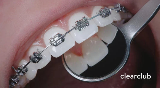 Close-up of a dentist checking the underside of a patient’s teeth with braces