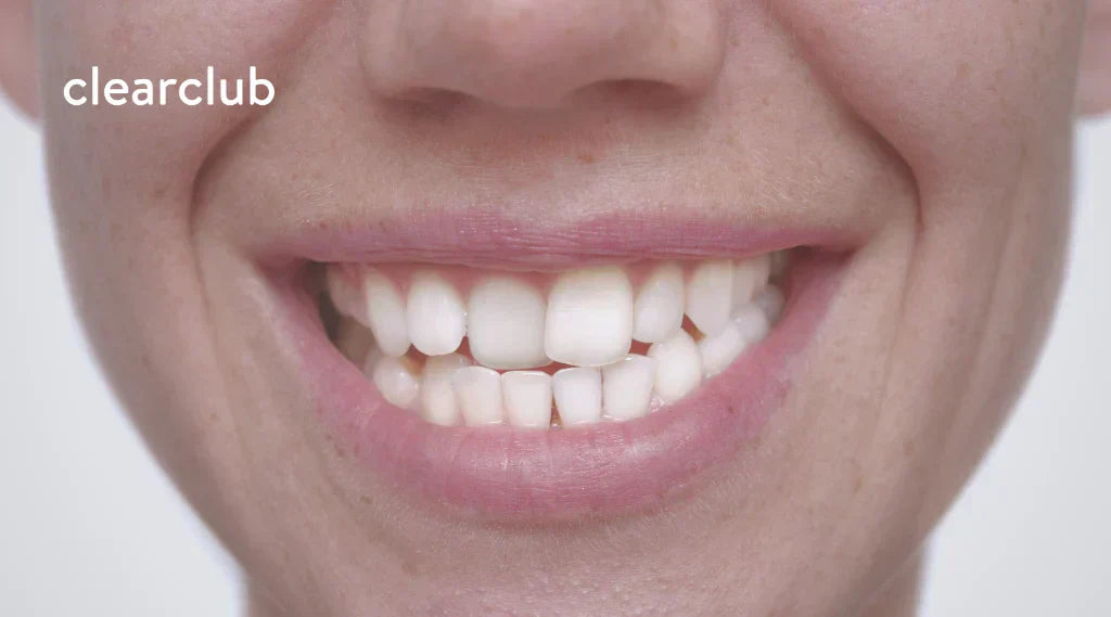 Woman smiling, showing her crooked teeth.
