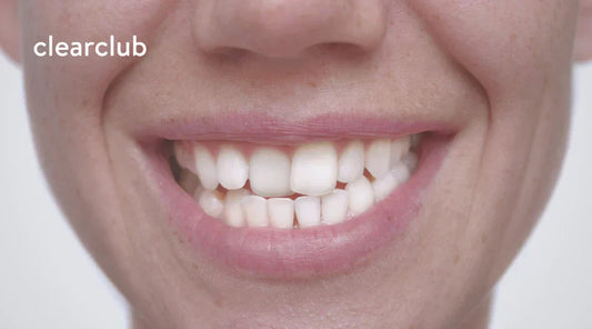 Woman smiling, showing her crooked teeth.