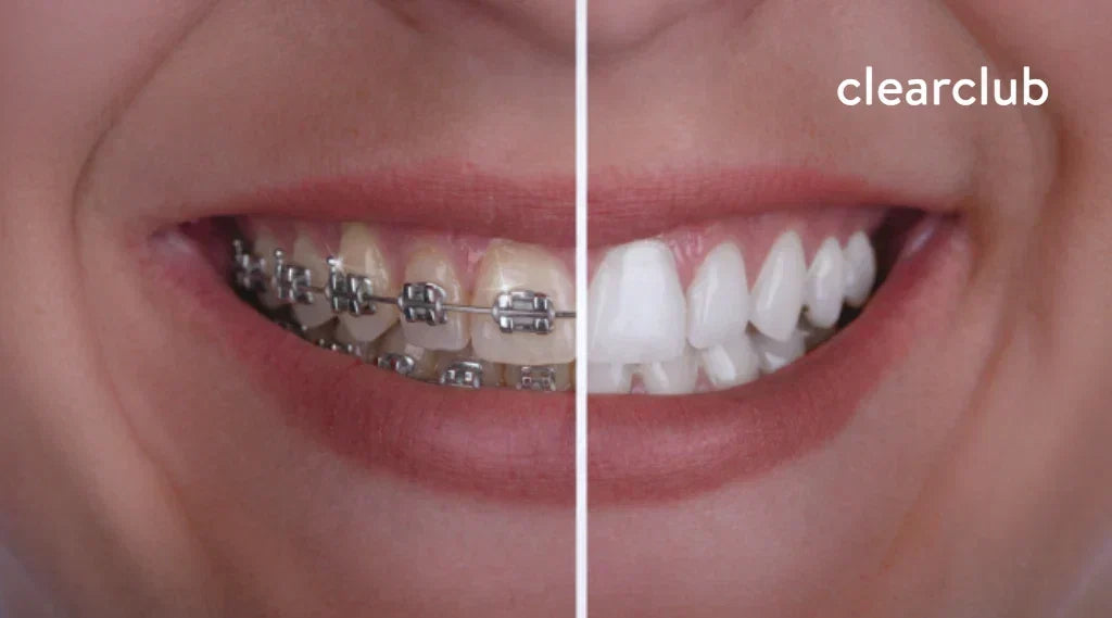 Before and after comparison of teeth with braces and whiter teeth after braces