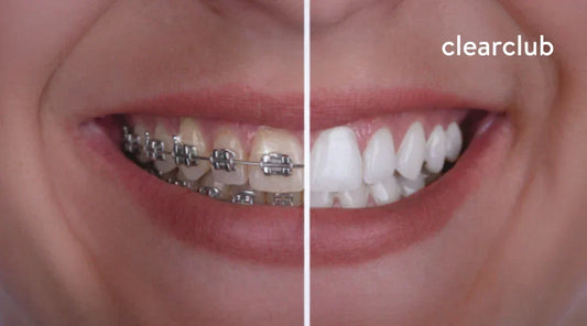 Before and after comparison of teeth with braces and whiter teeth after braces