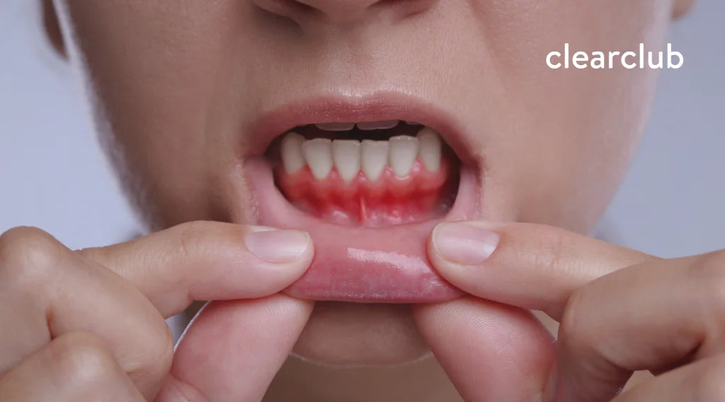 Woman pulling down her lower lip to show red, inflamed gums