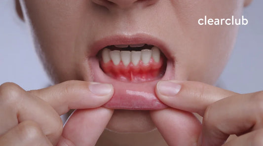 Woman pulling down her lower lip to show red, inflamed gums