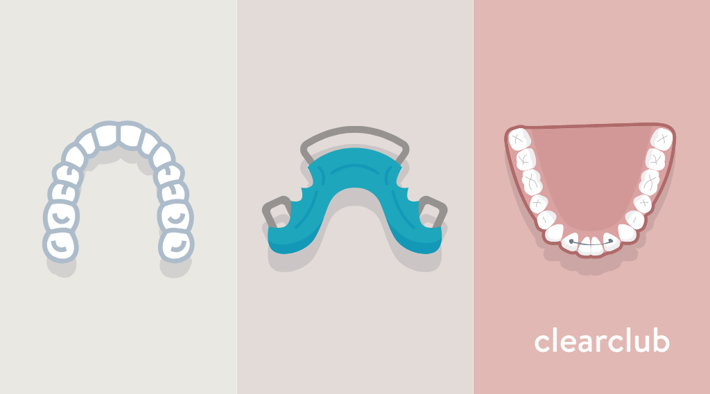 Clear vs. Hawley vs. Permanent Retainers: Which One Fits You Best?