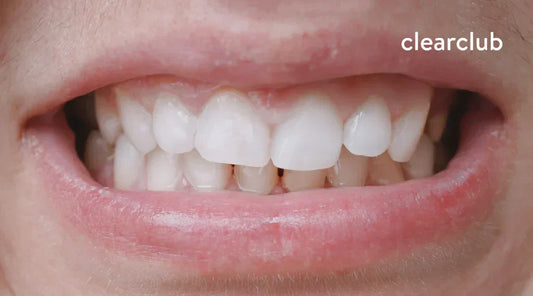 Bite feels misaligned after wearing a night guard