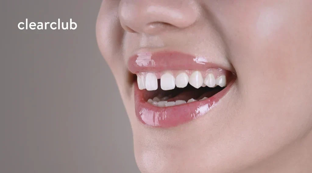 Woman smiling and showing a midline diastema, a common type of tooth gap